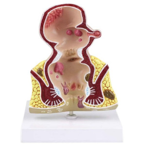 Model Anatomiczny Odbytu Hemoroidy Powiększenie 5x