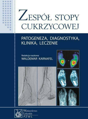 Zespół stopy cukrzycowej. Patogeneza, diagnostyka, klinika, leczenie