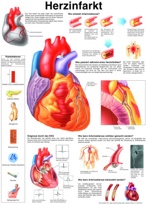 «Herzinfarkt», laminiert Poster 50 x 70 cm laminiert