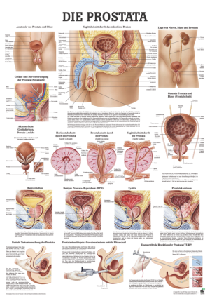 «Die Prostata», laminiert Tafel 70 x 100 cm laminiert