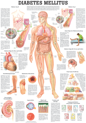 «Diabetes Mellitus», laminiert Tafel 70 x 100 cm laminiert